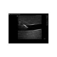 Load image into Gallery viewer, Gen II Central Line and Regional Anesthesia Replacement Insert - American Hospital Supply
