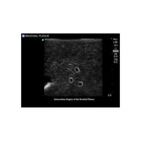 Load image into Gallery viewer, Gen II Central Line and Regional Anesthesia Replacement Insert - American Hospital Supply
