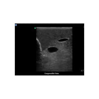 Load image into Gallery viewer, Gen II Central Line and Regional Anesthesia Replacement Insert - American Hospital Supply

