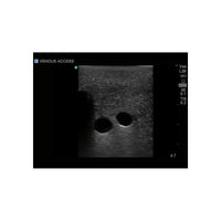 Load image into Gallery viewer, Gen II Central Line and Regional Anesthesia Replacement Insert - American Hospital Supply
