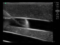 Load image into Gallery viewer, Gen II Ultrasound Central Line Training Model Replacement Tissue Insert - American Hospital Supply
