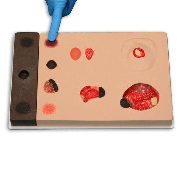Vata Pat Pressure Injury Staging Model - American Hospital Supply