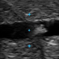 Load image into Gallery viewer, Vata Vascular Access Ultrasound Phantom - 3vein Bifurcated - American Hospital Supply
