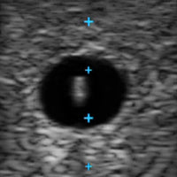 Load image into Gallery viewer, Vata Vascular Access Ultrasound Phantom - 3vein Bifurcated - American Hospital Supply
