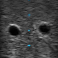 Load image into Gallery viewer, Vata Vascular Access Ultrasound Phantom - 3vein Bifurcated - American Hospital Supply
