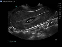 Load image into Gallery viewer, CAE Blue Phantom Pregnancy Transvaginal Ultrasound Training Model - American Hospital Supply
