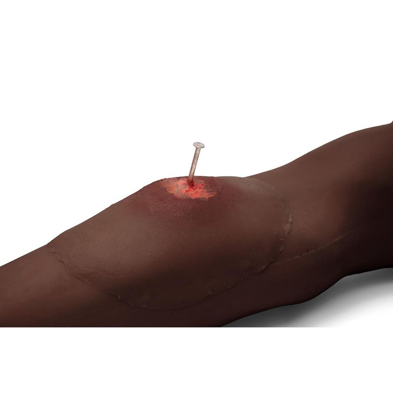 Sticky Wound Foreign Body: Nail - American Hospital Supply